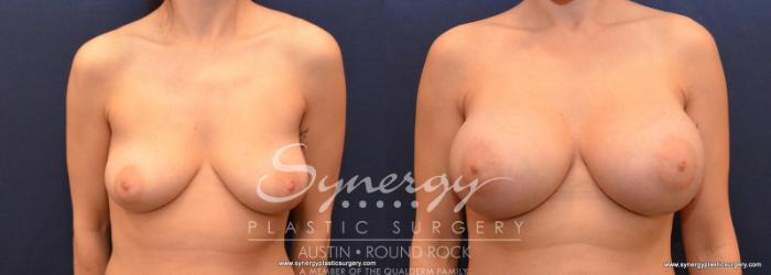 Before & After Breast Augmentation Case 597 View #1 View in Austin, TX