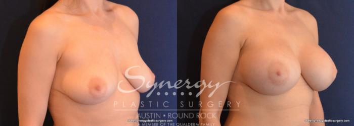 Before & After Breast Augmentation Case 597 View #2 View in Austin, TX