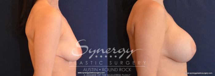 Before & After Breast Augmentation Case 597 View #3 View in Austin, TX