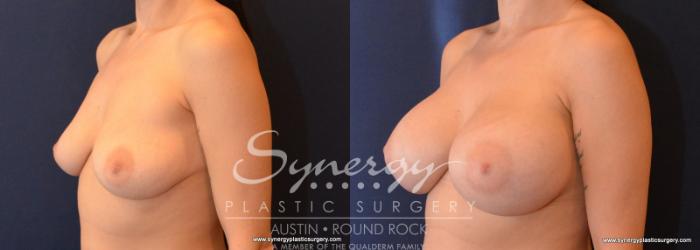 Before & After Breast Augmentation Case 597 View #4 View in Austin, TX