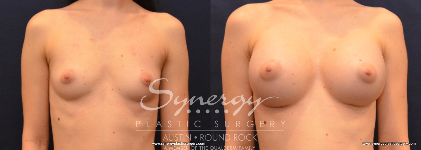 Before & After Breast Augmentation Case 598 View #1 View in Austin, TX