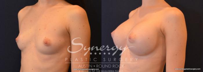 Before & After Breast Augmentation Case 598 View #2 View in Austin, TX