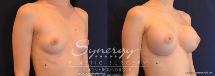 Before & After Breast Augmentation Case 598 View #3 View in Austin, TX