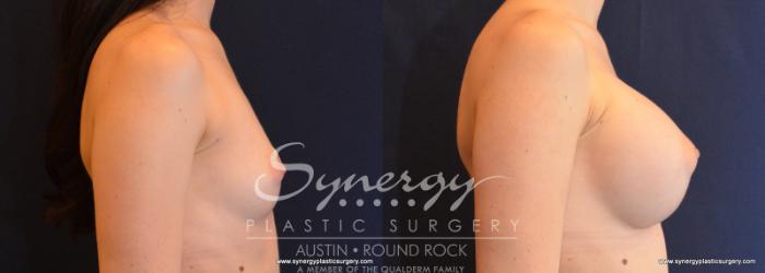 Before & After Breast Augmentation Case 598 View #4 View in Austin, TX