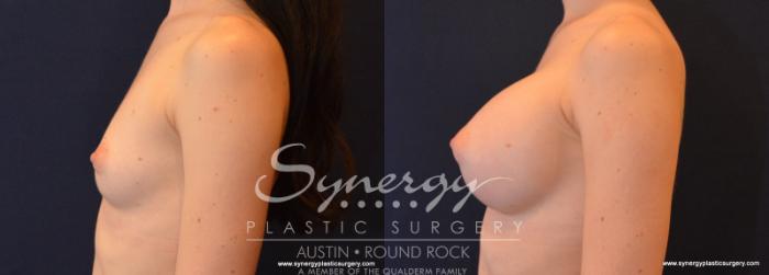 Before & After Breast Augmentation Case 598 View #5 View in Austin, TX