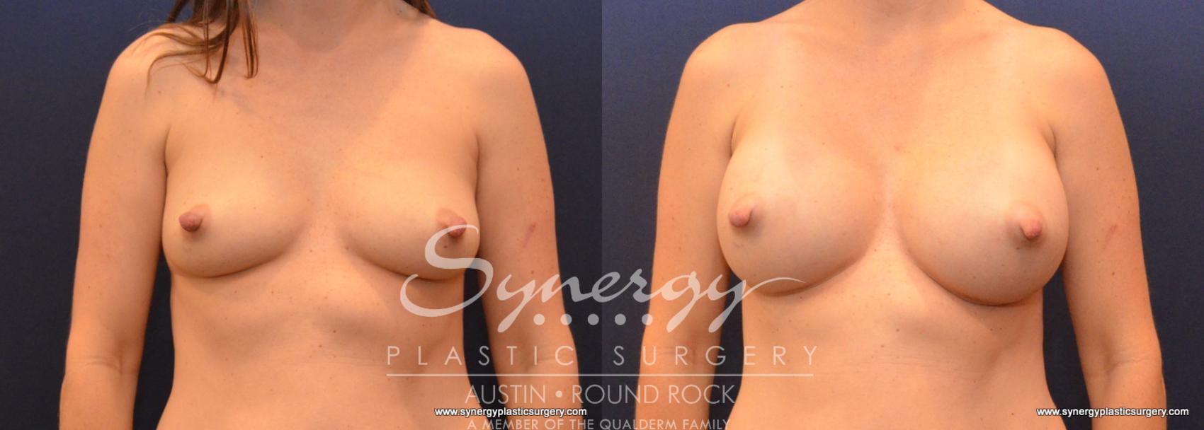 Before & After Breast Augmentation Case 602 View #1 View in Austin, TX