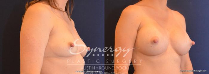 Before & After Breast Augmentation Case 602 View #2 View in Austin, TX