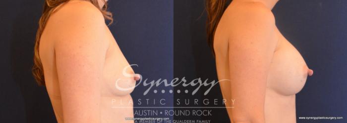 Before & After Breast Augmentation Case 602 View #3 View in Austin, TX
