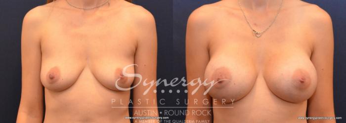 Before & After Breast Augmentation Case 604 View #1 View in Austin, TX