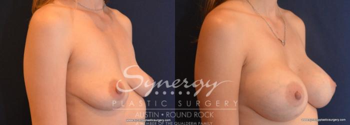 Before & After Breast Augmentation Case 604 View #2 View in Austin, TX