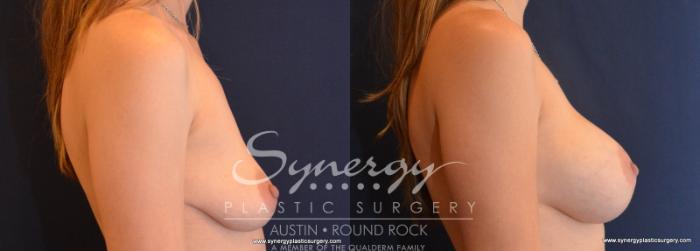 Before & After Breast Augmentation Case 604 View #3 View in Austin, TX