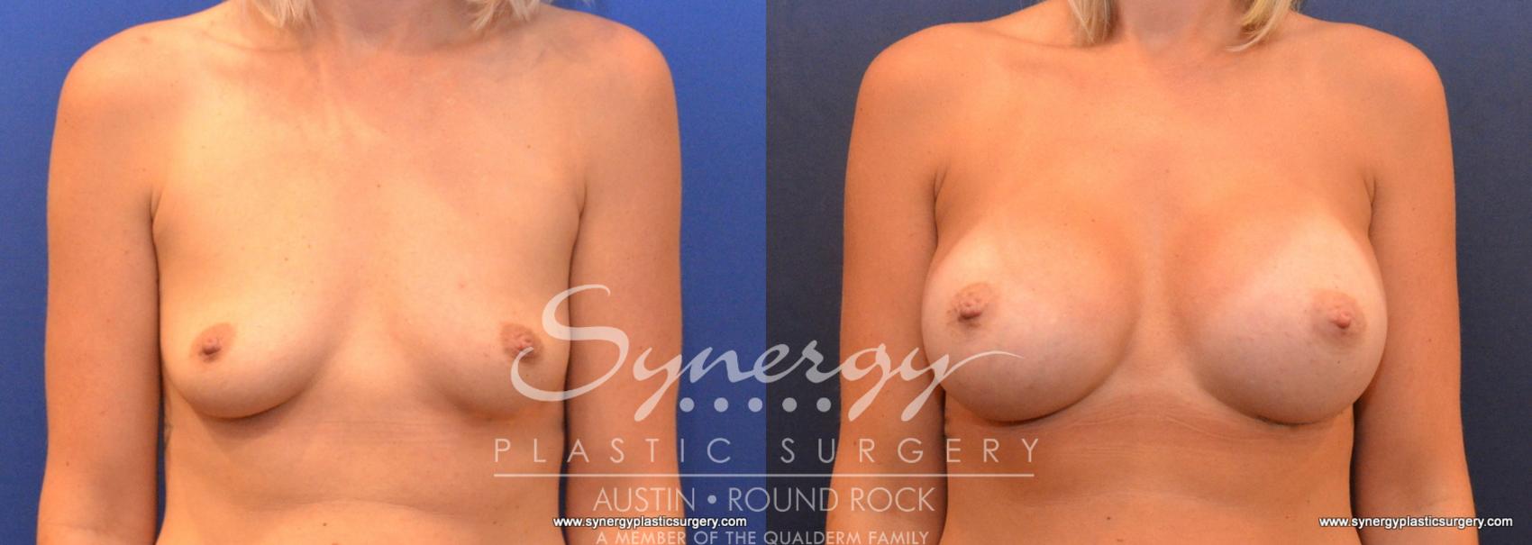 Before & After Breast Augmentation Case 606 View #1 View in Austin, TX