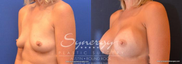 Before & After Breast Augmentation Case 606 View #2 View in Austin, TX