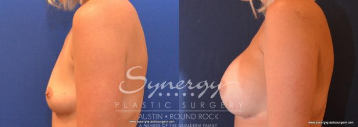 Before & After Breast Augmentation Case 606 View #3 View in Austin, TX