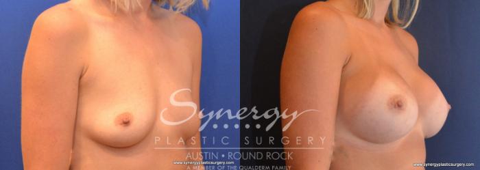 Before & After Breast Augmentation Case 606 View #4 View in Austin, TX