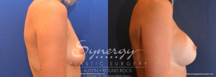 Before & After Breast Augmentation Case 606 View #5 View in Austin, TX