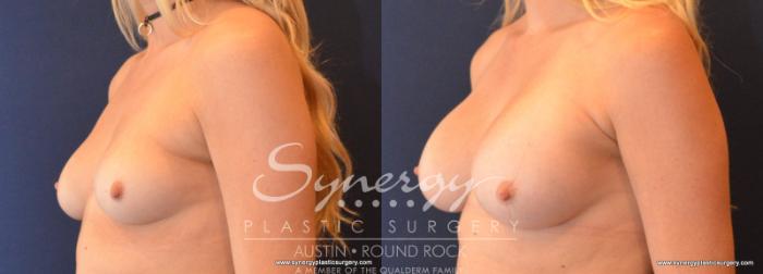 Before & After Breast Augmentation Case 609 View #2 View in Austin, TX
