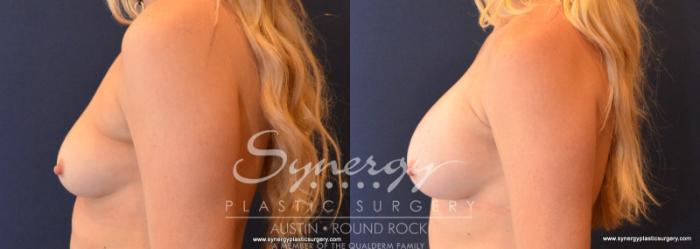 Before & After Breast Augmentation Case 609 View #3 View in Austin, TX