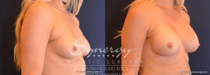Before & After Breast Augmentation Case 609 View #4 View in Austin, TX