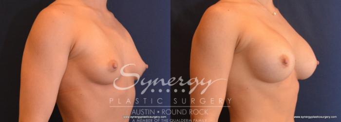 Before & After Breast Augmentation Case 611 View #2 View in Austin, TX