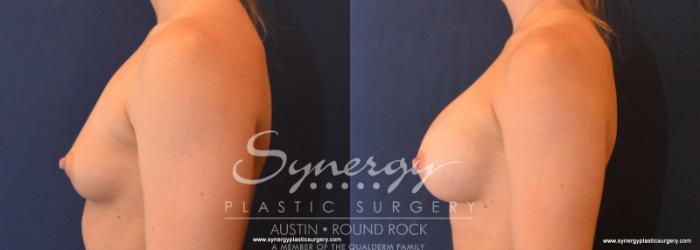 Before & After Breast Augmentation Case 611 View #5 View in Austin, TX