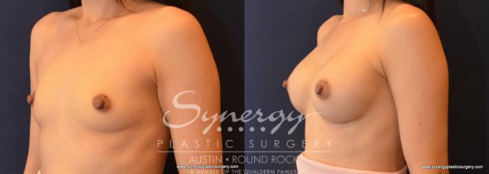 Before & After Breast Augmentation Case 613 View #2 View in Austin, TX