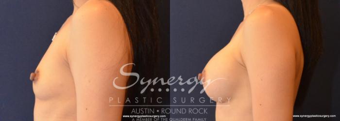 Before & After Breast Augmentation Case 613 View #3 View in Austin, TX