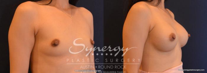 Before & After Breast Augmentation Case 613 View #4 View in Austin, TX