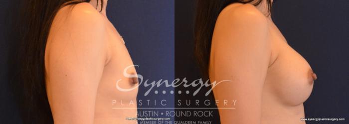 Before & After Breast Augmentation Case 613 View #5 View in Austin, TX
