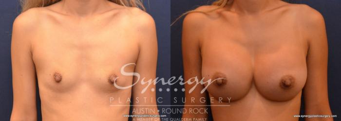 Before & After Breast Augmentation Case 614 View #1 View in Austin, TX