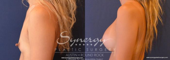 Before & After Breast Augmentation Case 614 View #2 View in Austin, TX
