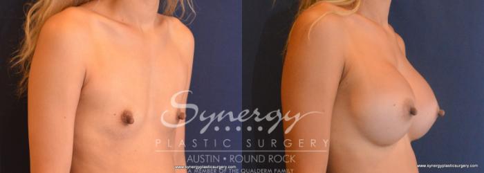 Before & After Breast Augmentation Case 614 View #3 View in Austin, TX