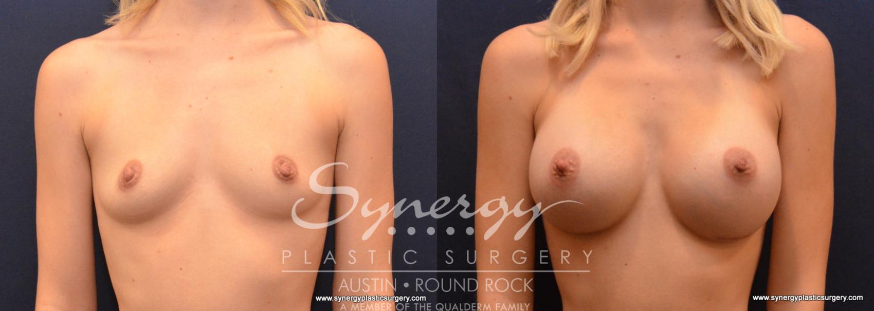 Before & After Breast Augmentation Case 615 View #1 View in Austin, TX
