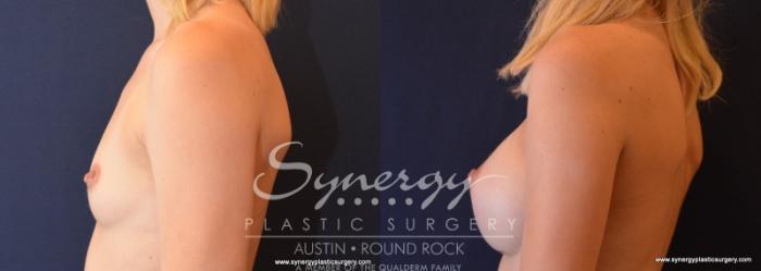 Before & After Breast Augmentation Case 615 View #3 View in Austin, TX