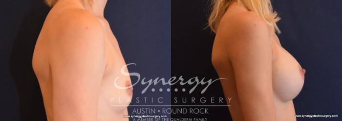 Before & After Breast Augmentation Case 615 View #5 View in Austin, TX