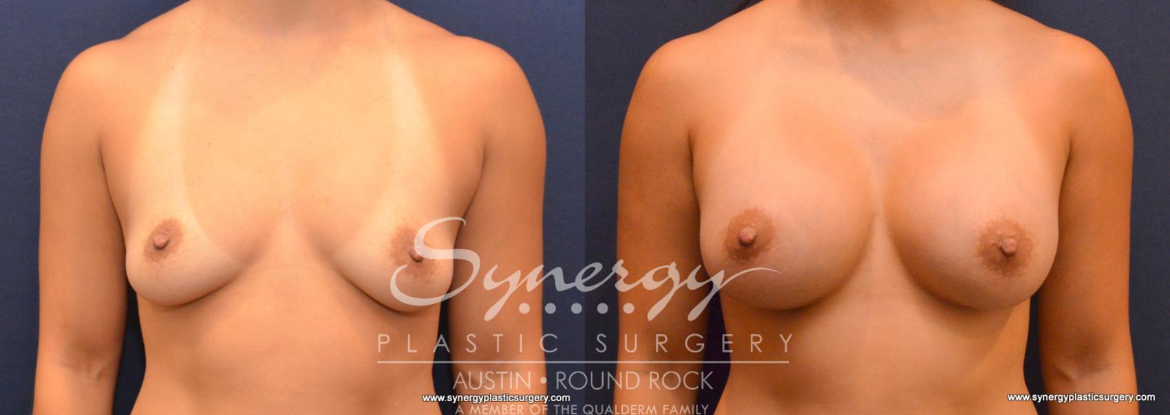 Before & After Breast Augmentation Case 616 View #1 View in Austin, TX
