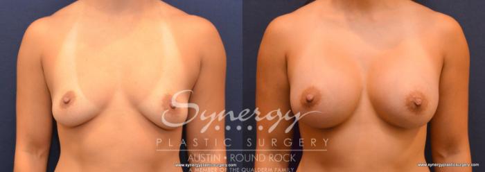 Before & After Breast Augmentation Case 616 View #1 View in Austin, TX