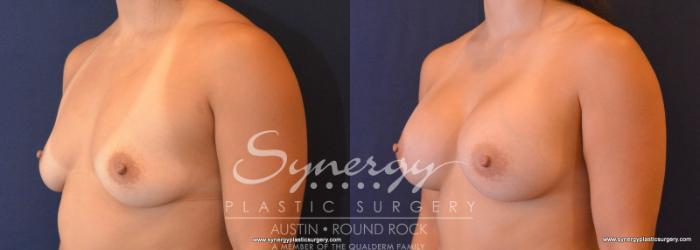 Before & After Breast Augmentation Case 616 View #2 View in Austin, TX