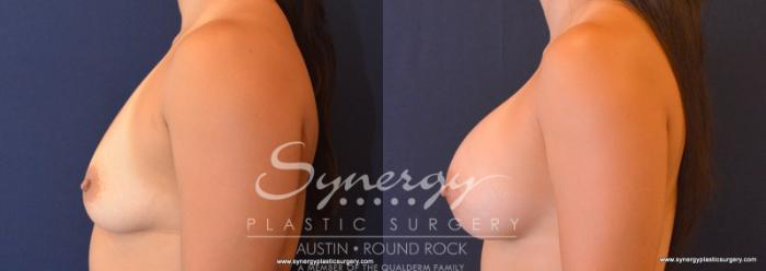 Before & After Breast Augmentation Case 616 View #3 View in Austin, TX