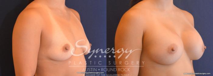 Before & After Breast Augmentation Case 616 View #4 View in Austin, TX