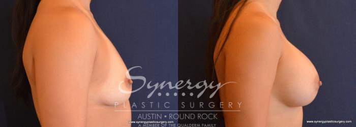 Before & After Breast Augmentation Case 616 View #5 View in Austin, TX