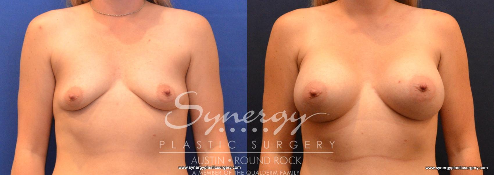 Before & After Breast Augmentation Case 618 View #1 View in Austin, TX