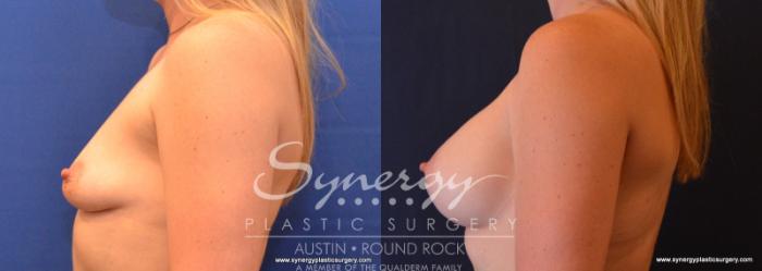 Before & After Breast Augmentation Case 618 View #3 View in Austin, TX