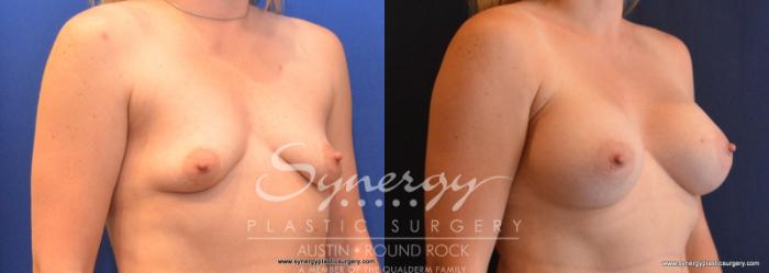 Before & After Breast Augmentation Case 618 View #4 View in Austin, TX