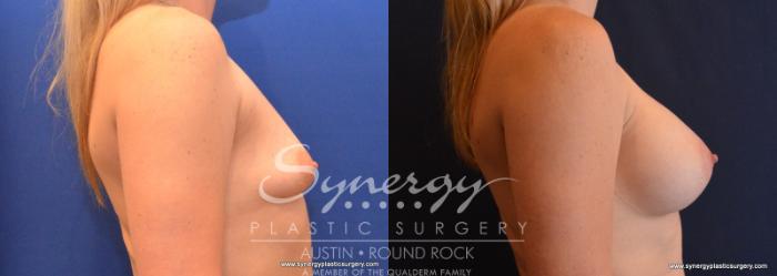 Before & After Breast Augmentation Case 618 View #5 View in Austin, TX