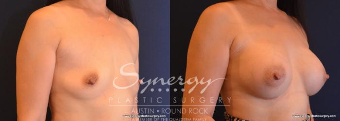 Before & After Breast Augmentation Case 619 View #2 View in Austin, TX
