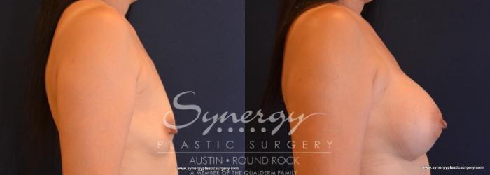Before & After Breast Augmentation Case 619 View #3 View in Austin, TX