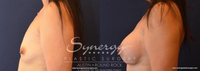 Before & After Breast Augmentation Case 619 View #5 View in Austin, TX