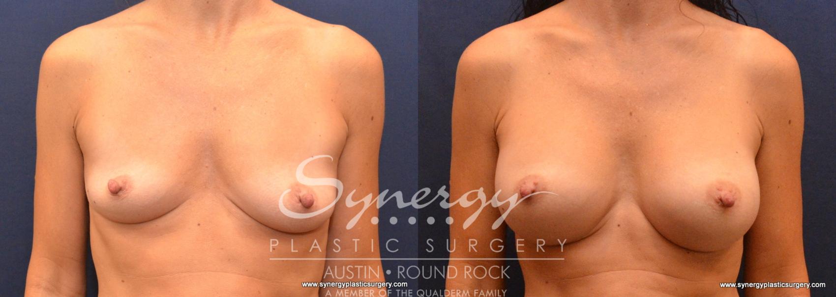 Before & After Breast Augmentation Case 620 View #1 View in Austin, TX