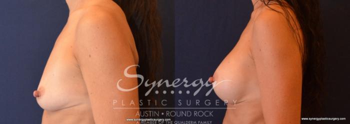Before & After Breast Augmentation Case 620 View #3 View in Austin, TX